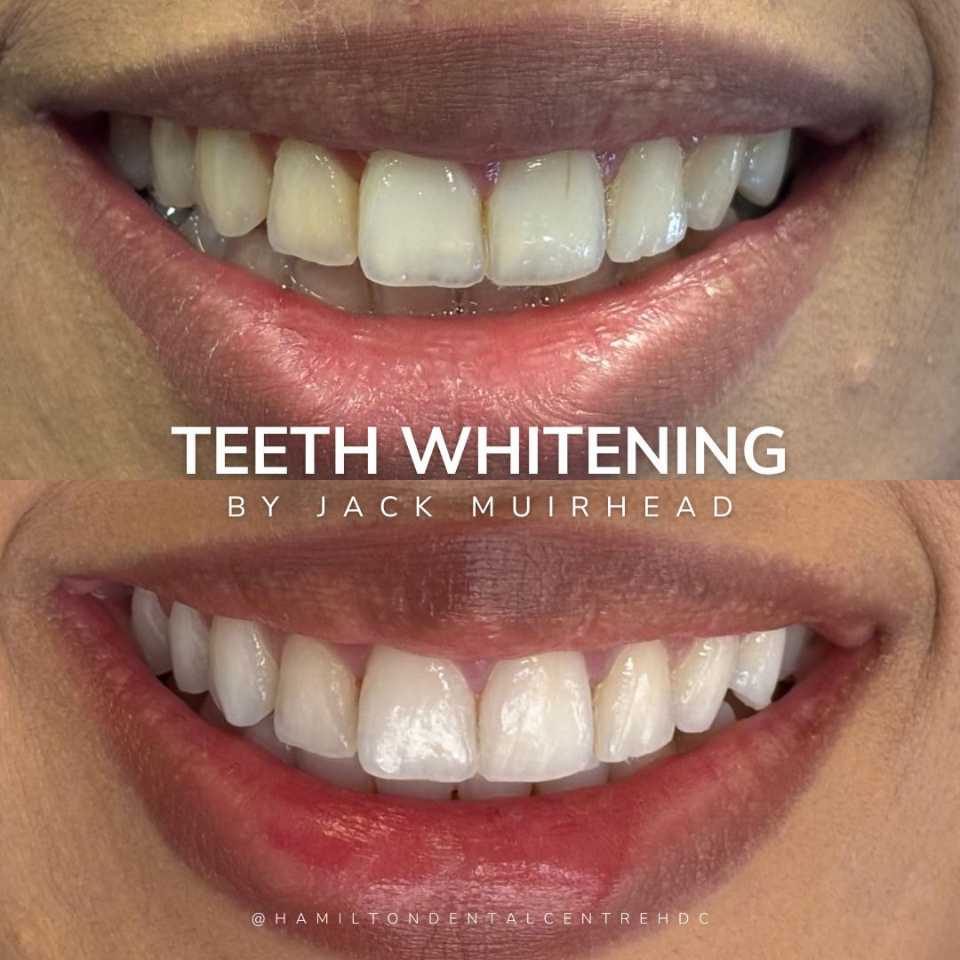 Teeth Whitening in Hamilton