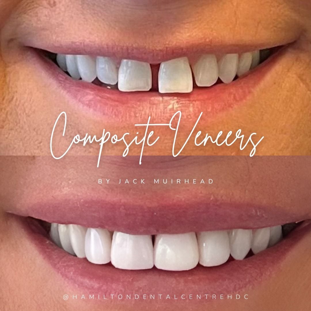 Smile Design in Hamilton
