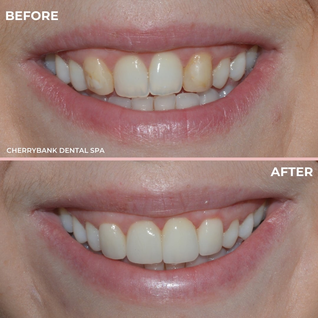 Composite Bonding vs Veneers Hamilton