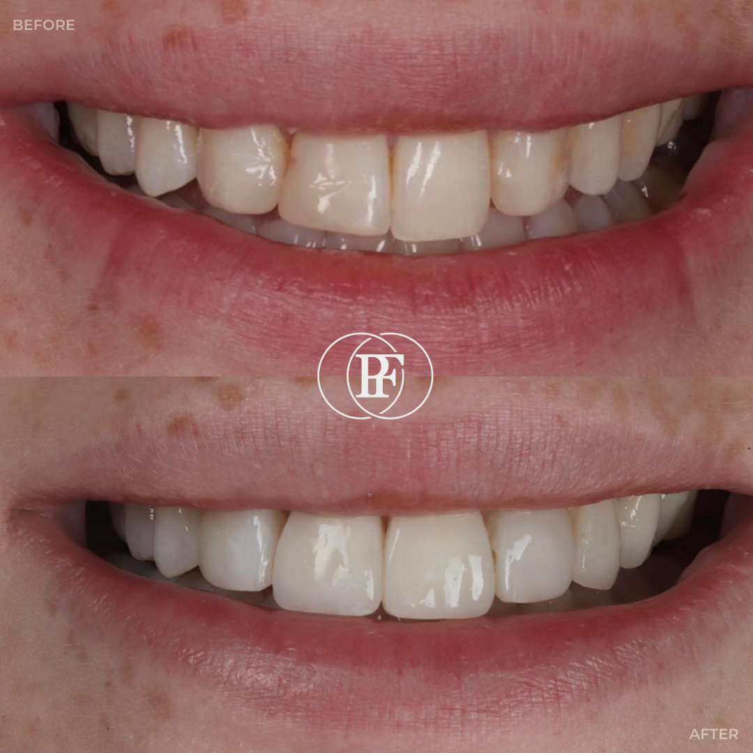 Hamilton Dental Centre Smile Gallery Hamilton Dental Centre Smile Gallery