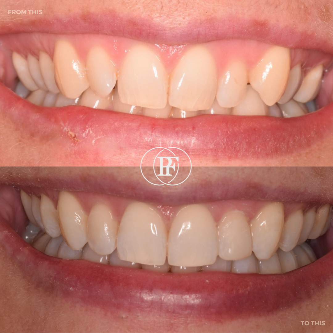 Hamilton Dental Centre Smile Gallery Hamilton Dental Centre Smile Gallery