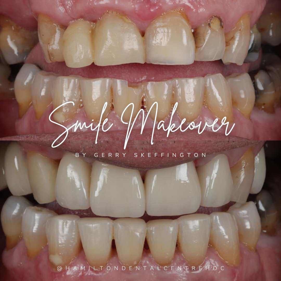 Hamilton Dental Centre Smile Makeovers in Hamilton