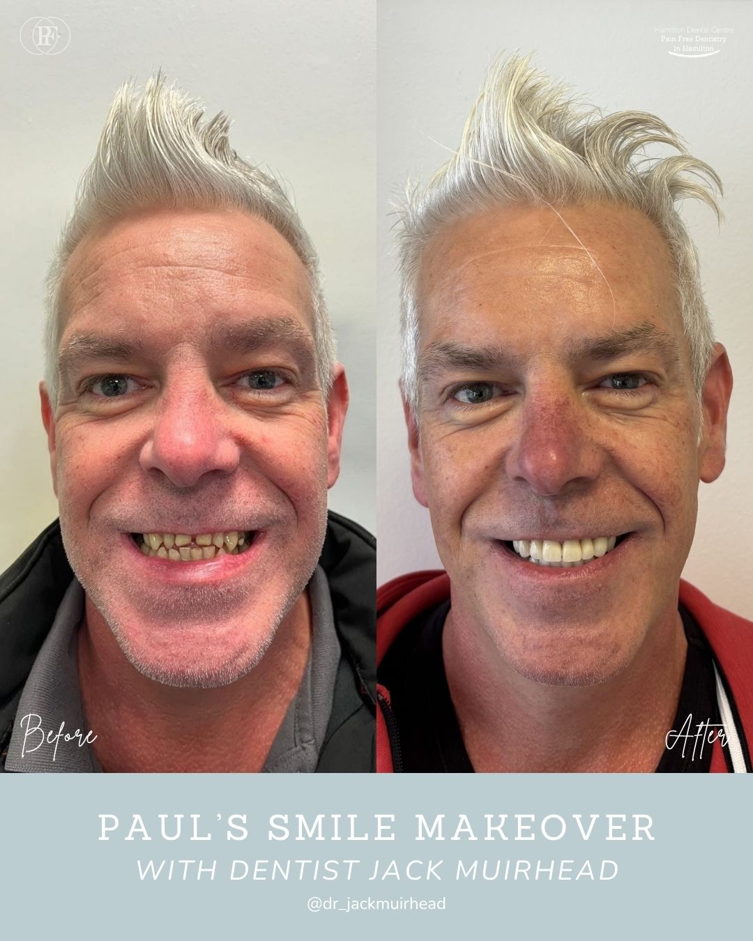 Hamilton Dental Centre Paul's Smile Story Hamilton Dental Centre Paul's Smile Story